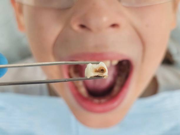 Best Emergency Tooth Extraction in Brownsville, OR
